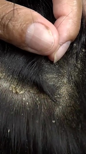 Remove Psoriasis Scalp #ASMR #asmrsound #removal #dandruff #psoriasis #scratching #facebookreels #reelsfb #combingdandruff #asmrsounds #reelsvideo #fyp #hugeflakes | Dandruff Media