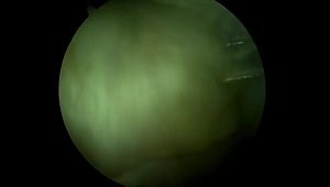 Arthroscopic Fixation of a Tibial Intercondylar Eminence Fracture