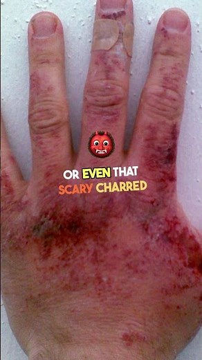 what the sign of burn?