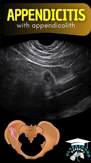 Diagnosing Appendicitis in Young Adults: Ultrasound Case Study #ultrasound #appendicitis