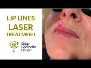 Lip Lines Sciton LaserTreatment- Rejuv Cosmetic Center NJ