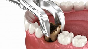 Extraction Damaged Tooth Dental 3d Animation Stock Footage Video (100% Royalty-free) 1101436777 | Shutterstock