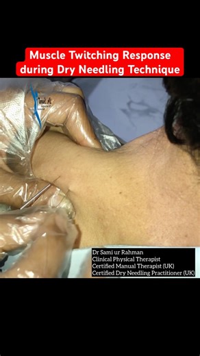 Is it time to rethink how we treat trapezius trigger points pain?