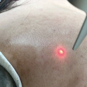 Revlite is a Q-Switched Nd:Yag laser with 1064 nm or 532 nm wavelength that uses non-invasive light energy to gently stimulate skin’s natural collagen. Furthermore, years of sun exposure and other environmental factors result in pigmentation (like freckles, melasma and sun spots), redness, and enlarged pore size. Revlite is the best way to treat these skin problems and is indeed proven to minimize pores, treat unwanted pigmentation, rejuvenate the skin, and enhance collagen regeneration. Revlite