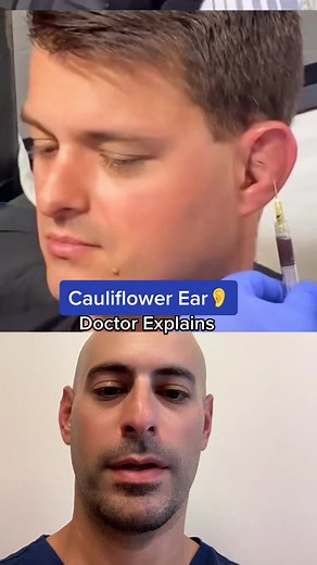 Cauliflower Ear Treatment Explained by Doctor