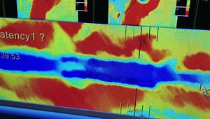 1.3K views · 13 reactions | This is an example of in-stent restenosis...