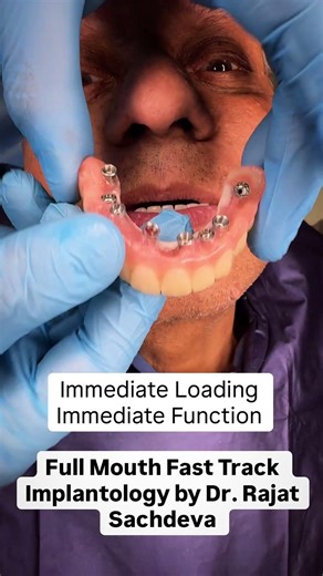 Immediate Loading vs Immediate Function in Full-Mouth Dental Implants | Key Clinical Principles