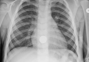 Perceptual Error and Radiology Well-Being