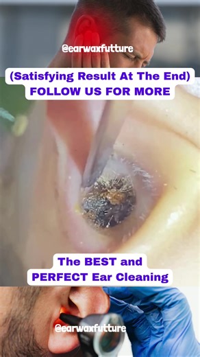Effective Ear Wax Removal Techniques for a Clean Ear
