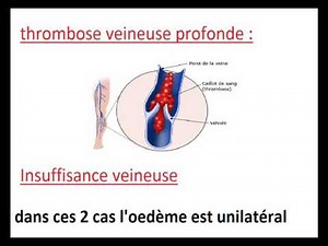 oedème des membres inférieurs