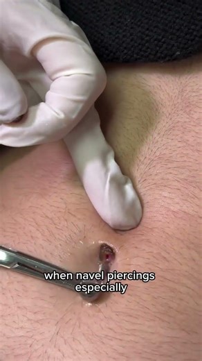 Navel Piercing Bump Treatment | How to Care for Belly Button Piercings 💧