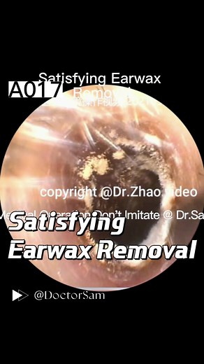 Dr. Zhao Ear Wax Removal with Camera: Expert Ear Cleaning Services