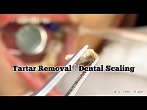 Tartar calculus removal Dental Scaling | Karang Gigi