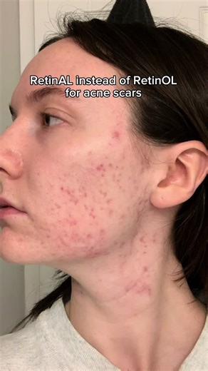 Retinal by KSECRET is for the acne girlies with extra sensitive skin! @KSECRET GLOBAL Works like a retinol but is less harsh on the skin 💕 #acneskincare #acnescars #acnescarsremoval #koreanskincare #ksecret #retinal