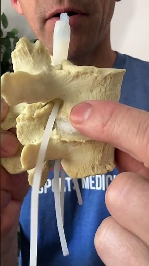 Lumbar Disc degeneration #lowerbackpain #sciatica #backpain