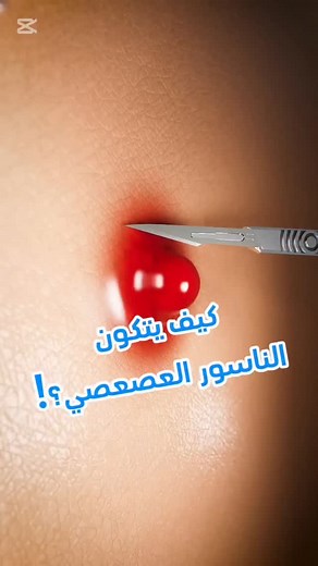 Dr. Leith Dhirar on Instagram‎: "كيف يتكون الناسور العصعصي..ومن اين ياتي الشعر؟! #جراحة_عامة #طب #اكسبلور #معلومات_طبية #ناسور_عصعصي"‎