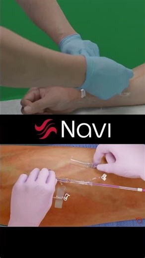 NAVI Needle-Free Blood Collection is FINALLY HERE!