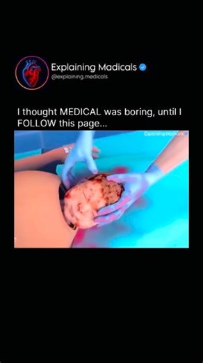 Medical | Health | Anatomy on Instagram: "A cesarean section (C-section) is a surgical procedure used to deliver a baby through incisions made in the mother’s abdomen and uterus. It is performed when a vaginal birth could put the mother or baby at risk, or when complications arise during labor. The process begins with anesthesia—usually spinal or epidural—so the mother remains awake but pain-free. The abdomen is cleaned and sterilized, then a horizontal incision is made just above the pubic hair