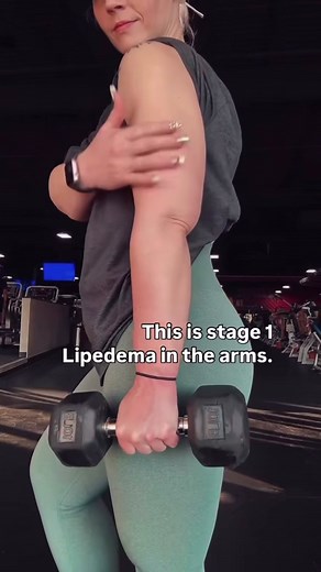 If you’re viewing from TikTok, you can access all of my top lipedema resources by visiting the link in my bio. For my main lipedema page, you can also follow me on IG under sarah.whitlow_ ❤️❤️ This is what my arm looks like today with Stage 1 Lipedema. You can see the shape. You can see the definition. You can even see muscle tone. And that’s why I wanted to show you this moment, not just the arm I have now, but what it used to be. What you also see is: Photos of me at Stage 3, when my arms were
