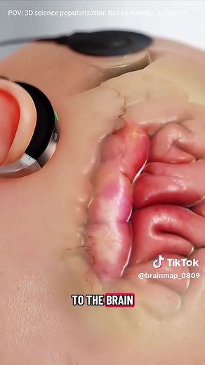 How Cochlear Implant Works? (3D Animation)#cochlearimplant #cochlearimplants #hearingloss #hearinglossprevention #hearinglossawareness #hearingaids #cochlearimplantsurgery #medical3danimation #3dmedicalanimation