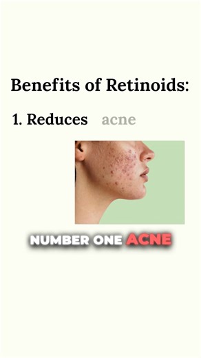 Retinoids are one of the most misunderstood acne treatments — and also one of the most effective. If you really want to get to the root cause of acne, you have to treat the comedone. That clogged pore is where acne begins. Retinoids help unclog pores, make sebum less sticky, fade lingering dark spots, and support collagen so skin heals better over time. 👀 Watch the full episode of The Skin Real on YouTube or wherever you get your podcasts for a deeper breakdown of how retinoids work and how to 