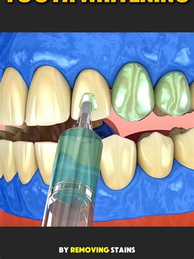 How Tooth Whitening Is Done (3D Animation) #medical3danimation #3dmed... | TikTok