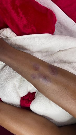 MICRONEEDLING FOR SCARS!If you’ve had any scar, or acneor surgery, microneedling for scars can restore your complexion. This treatment promotes the formation of new skin cells and accelerates healing. At the same time, it breaks down old scar tissue. Compared to other types of treatments, it’s cheaper and delivers faster results.Microneedling has been successfully used as a treatment for scars for several years. It involves creating micro-punctures in the skin, which help to break down old scar 