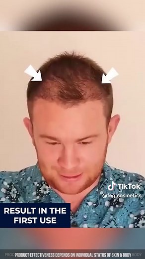 Hair gr0wth after 0ne weeks. Can you belive? Try #fegplus #hairserum now, link buy in bio!