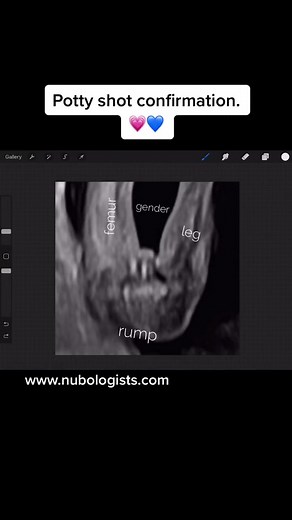 Potty shot confirmation. 💗💙 #nubologists #pottyshot #genderreveal #heorshe #ultrasound #sonogram #babygirl #genderprediction #nubtheory #babyscan