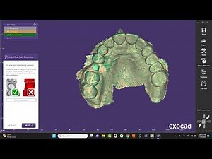 EXOCAD: Single Implant Crown