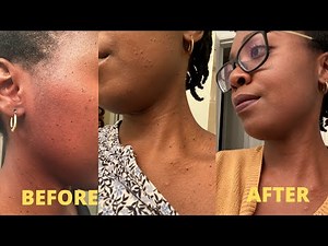 MY DPN (DERMATOSIS PAPULOSA NIGRA) REMOVAL EXPERIENCE AND REVIEW - WITH PICTURES