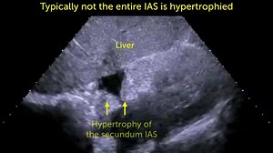 34K views · 792 reactions | 60 Seconds of Echo Teaching: See a typical echo case of a lipomatous interatrial septum. Learn how to identify it and what it means for the patient. PS You can still take part in our science survey on RVF: https://www.surveymonkey.com/r/ML5WG5Y | 123sonography | Facebook