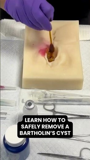 Bartholins cyst removal #shorts