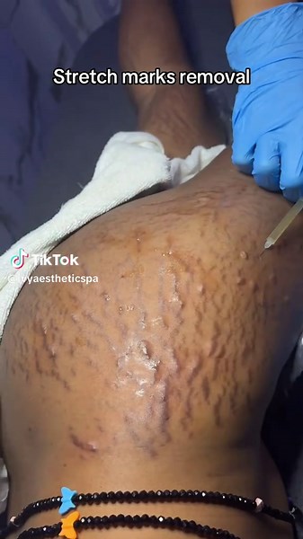 💉 Benefits of PRP   Microneedling for Stretch Marks 1️⃣ Stimulates collagen and elastin production – The microneedling creates tiny controlled injuries, and PRP (platelet-rich plasma) boosts healing — together they rebuild the skin’s structure. 2️⃣ Fades stretch marks gradually – Helps reduce the depth, color, and texture of old and new stretch marks. 3️⃣ Improves skin texture and tone – Smooths rough, uneven areas and makes the skin look firmer and more even. 4️⃣ Tightens and rejuvenates the s