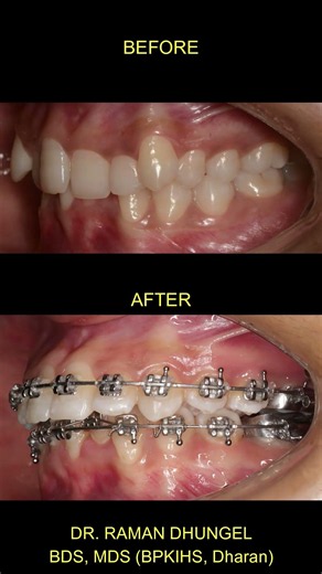 Teeth Before and After Orthodontic Treatment #braces #dentist