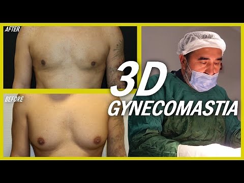 3D Gynecomastia Surgery Technique (MALE BREAST REDUCTION) #gynecomastia