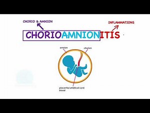CHORIOAMNIONITIS