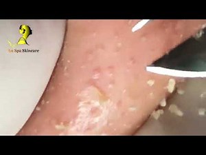 角栓 ブラックヘッド 角栓除去 ニキビ芯出し | ーニキビ #にきび治療 #BlackHeads #Whiteheads #Acnes #Dr.Somaria