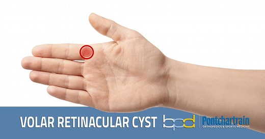 Volar Retinacular Cysts