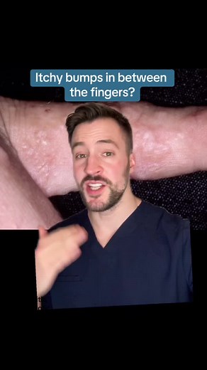 Itchy bumps and blisters in between the fingers? You might have this common skin condition! #dyshidroticeczema #eczema #dermatitis #eczematreatment