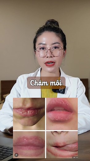 Chàm môi là gì?