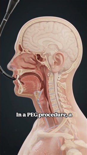 How a PEG Feeding Tube Works 🩺 #shorts #medical