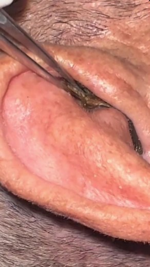 Eficiencia en la limpieza de cerumen