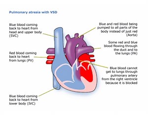 Pulmonary Atresia - Children's Heart Federation