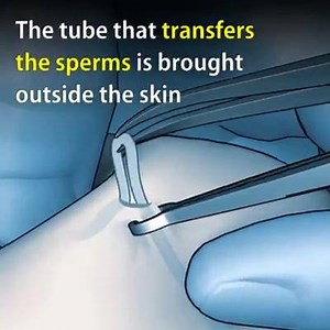 2.2K views · 24 reactions | Vesectomy!! MALE Sterilization(Male birth control procedure) | Dr.Ayaz Afridi | Facebook