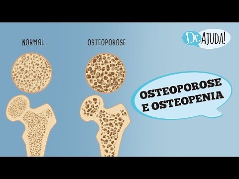 OSTEOPOROSE E OSTEOPENIA: O QUE SÃO? CAUSAS, DIAGNÓSTICOS E TRATAMENTOS