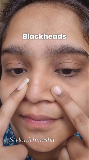 How to remove Blackheads at Home💗 #skincare #blackheads #facescrub #skincaretips #homeremedy #skin