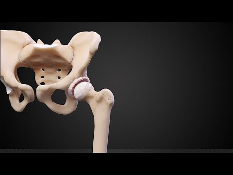 Acetabular Labral Reconstruction in Conjunction With a Periacetabular Osteotomy (PAO)