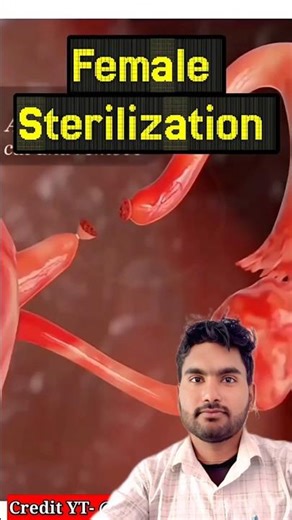 tubectomy ❤️ #tubectomy #birthcontrol #contraception #laproscopicsurgery