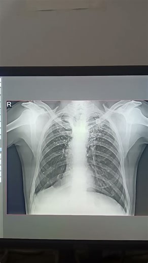 tuberculosis Rt minimal pleural effusion